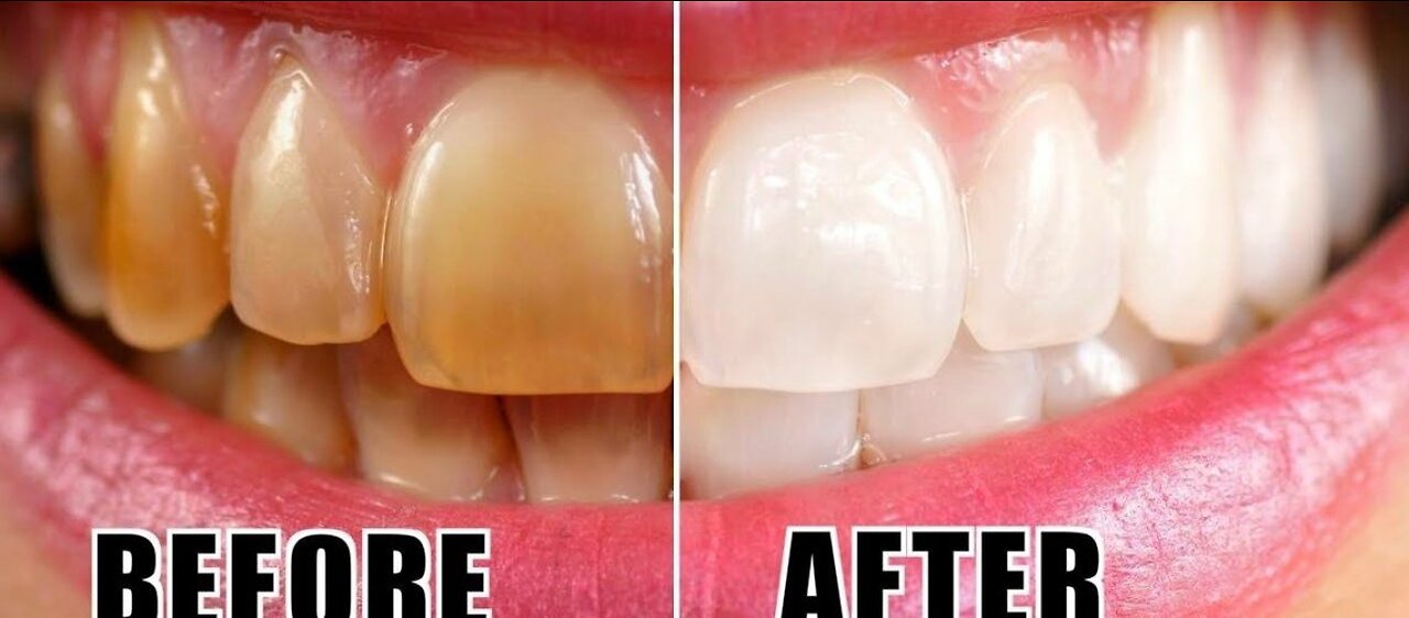 NATURAL TEETH WHITENER