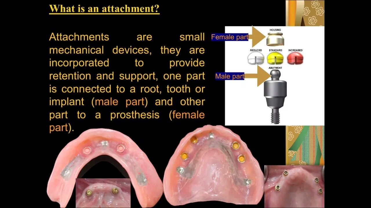 Prosthodontics L11 (Attachments in Overdenture)