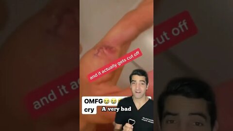 Finger Removal