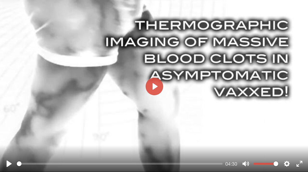 Thermographic Imaging Shows Massive Blood Clots in Asymptomatic Vaxxed!