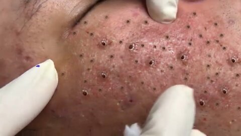 Removing Acne and Blackheads Treatment, #41