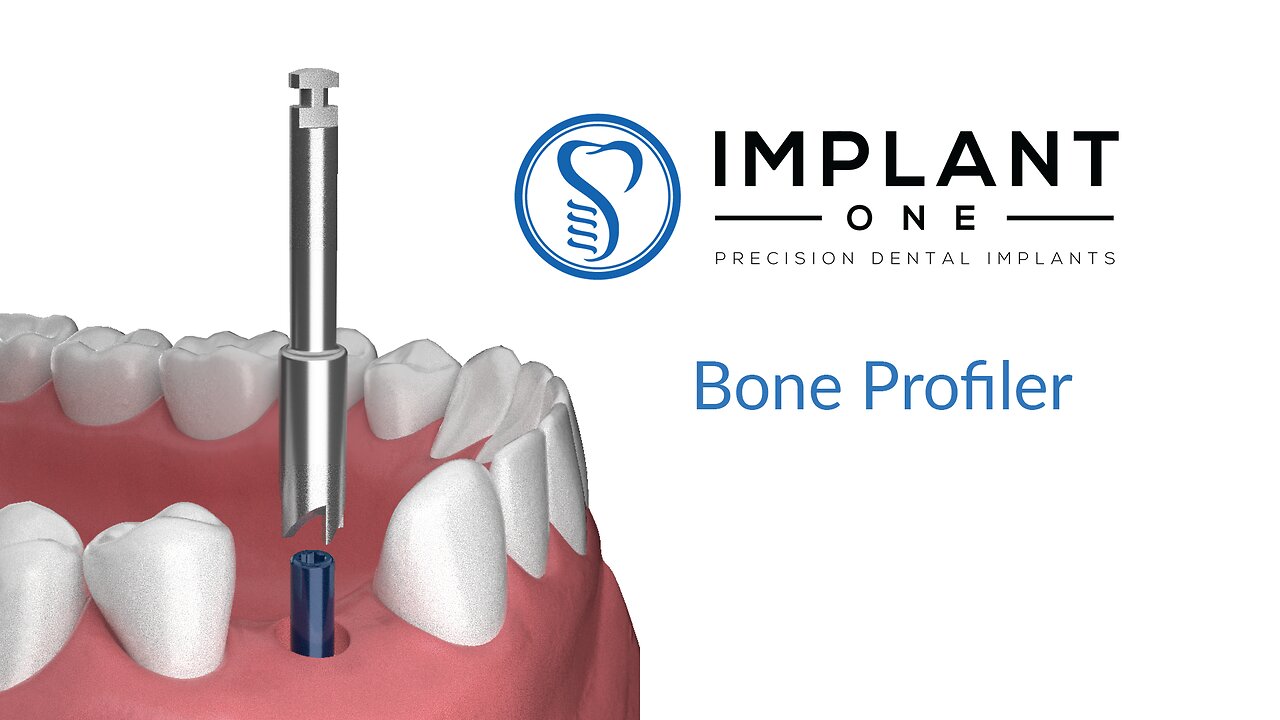 Implant One Bone Profiling Procedure