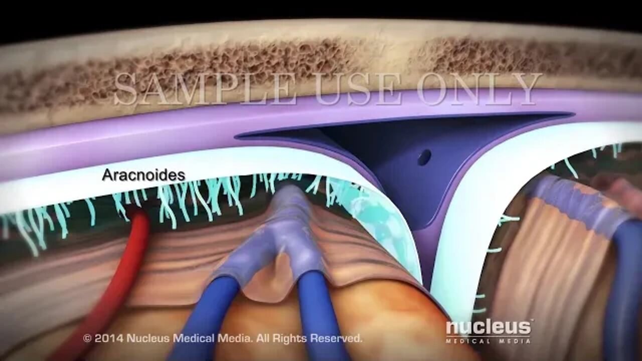 Craneotomía y craniectomía