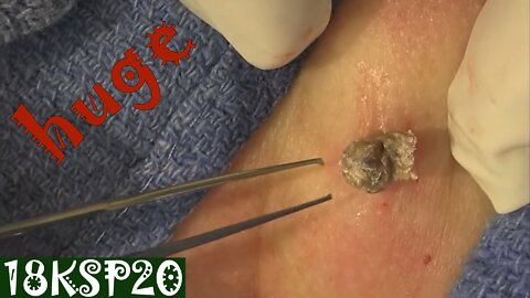 Huge Blackheads