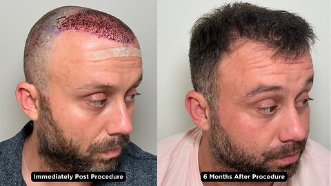 Post Surgery Patient Interview After Incredible 6 Month Transformation at Hair By Dr. Max!