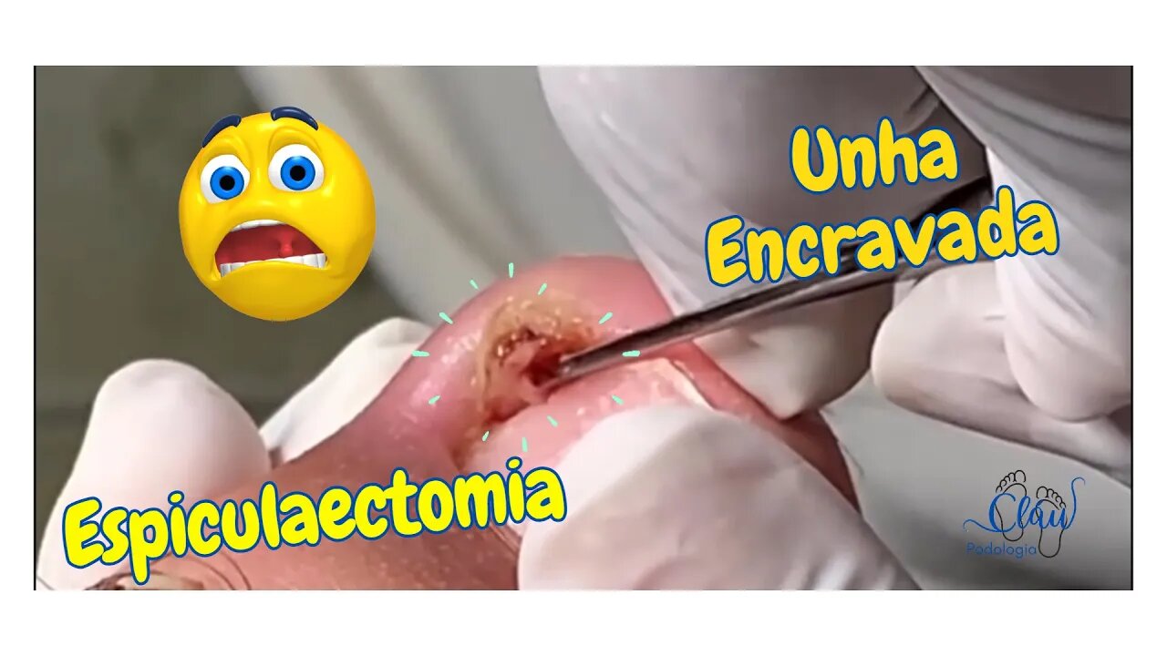 Espiculaectomia = UNHA dentro da PELE #unhas #pes #dor #podologia #unhaencravada #procedimento #102