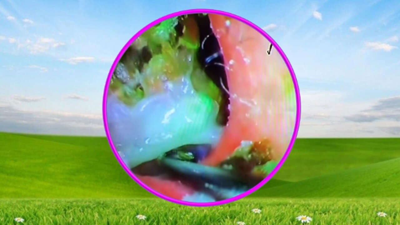 Earwax Extraction Relaxing with Flute Music #18