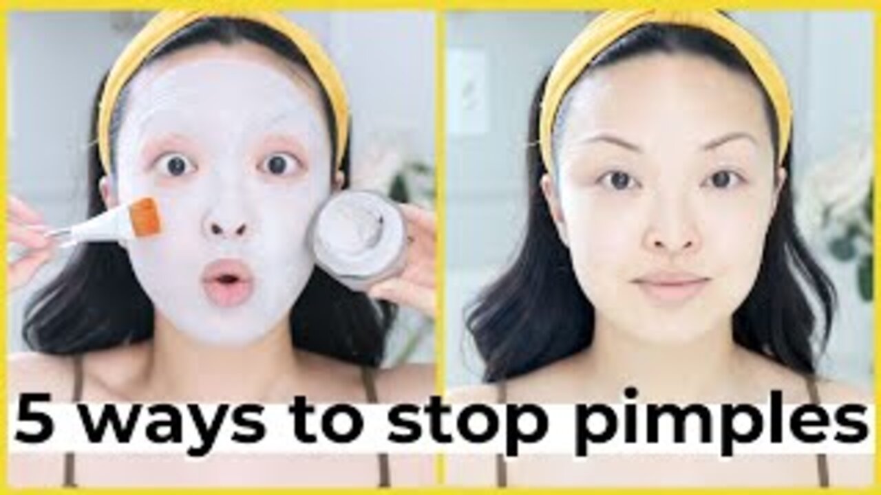 5 Way To Stop Acne & Pimples FAST!