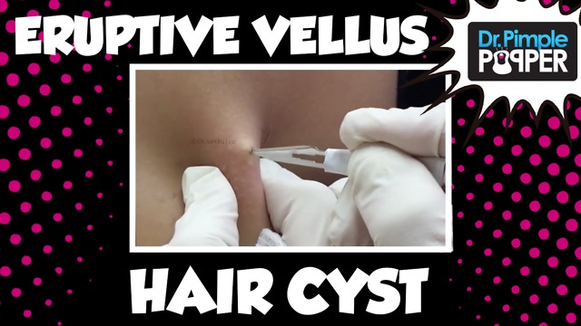 Unusual types of Cysts: Eruptive Vellus Hair Cysts, Part 1 in a Series