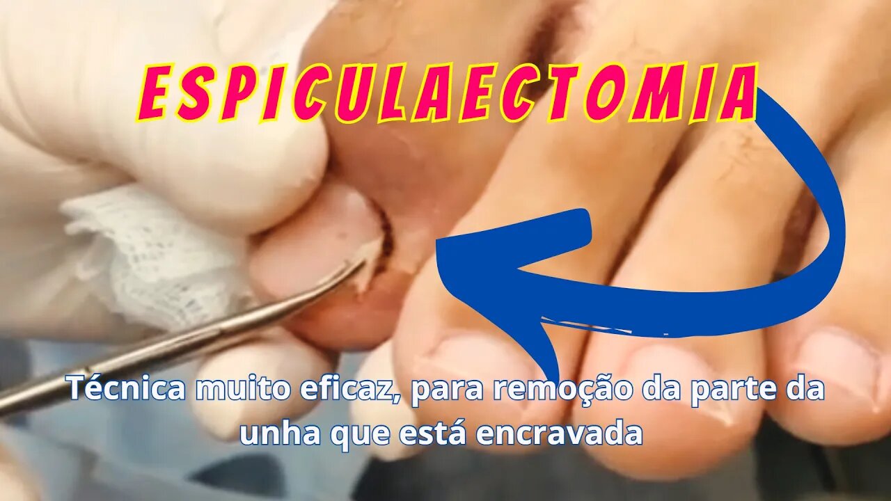 Procedimento ESPICULAECTOMIA | Unha Encravada #unhas #pes #dor #podologia #procedimento