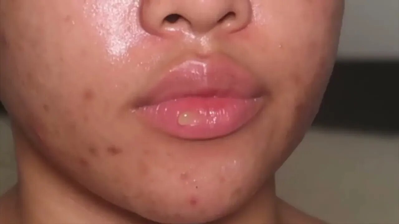 MAKEUP THERAPY 2 ACNE, RAW & UNFILTERED SATISFYING SAMANTHAEVIRA 7