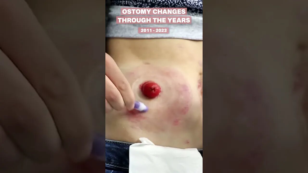 Ostomy Changes Through the Years | #shorts | Let's Talk IBD