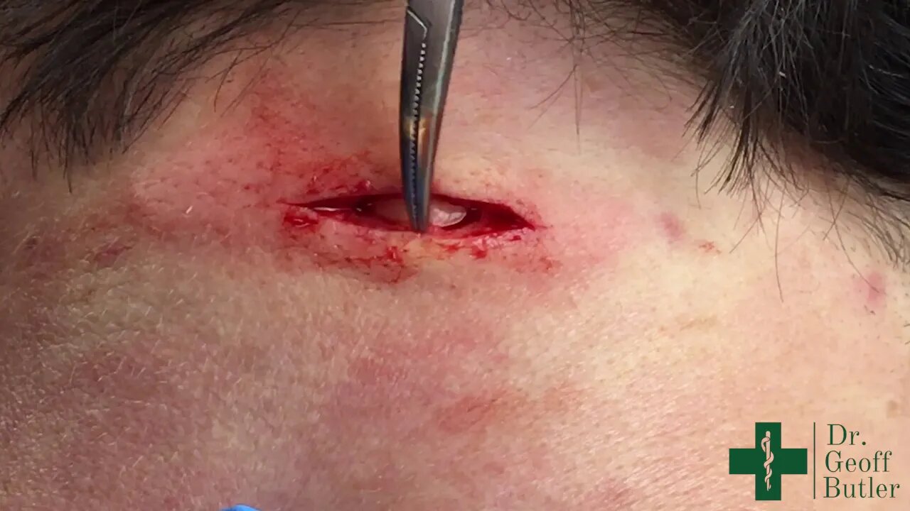 Removal of an Epidermal Cyst at the Nape of the Neck