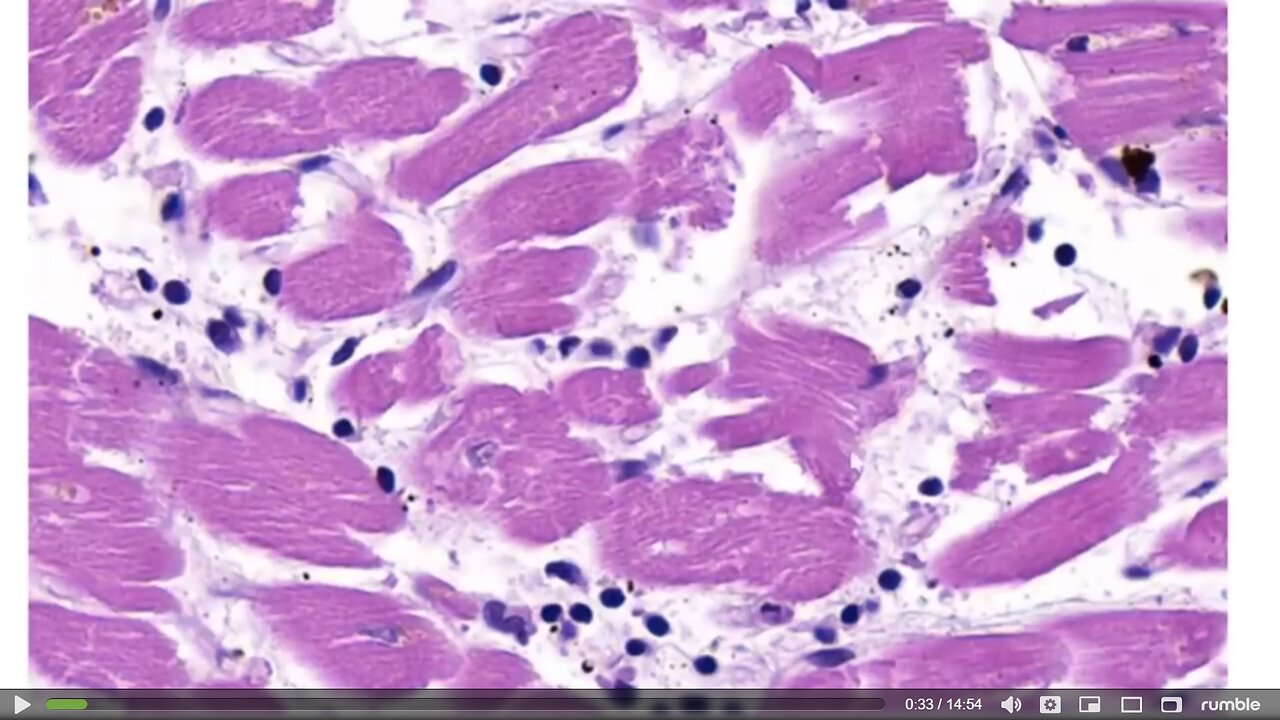 Myocarditis after m_RNA German evidence