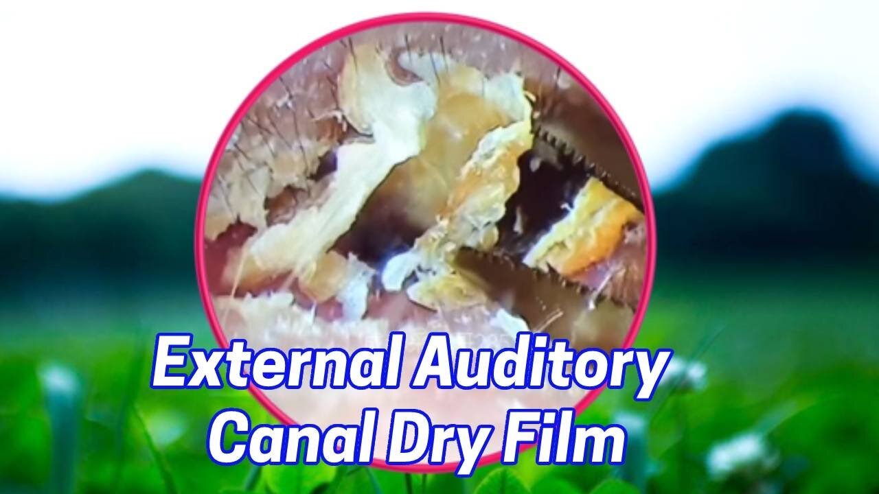 External Auditory Canal Fungus Dry Skin