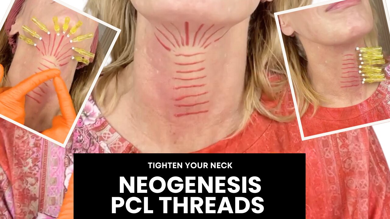 Tighten the Neck with Neogenesis PCL Threads - Neck Pattern