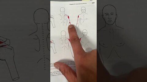 Supraspinatus Trigger Points