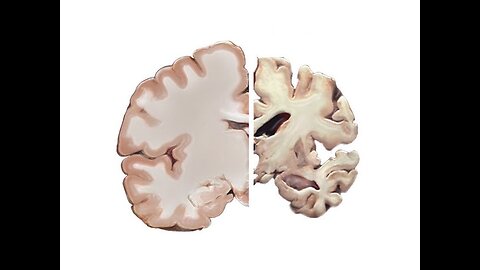 Alzheimer's and the Brain