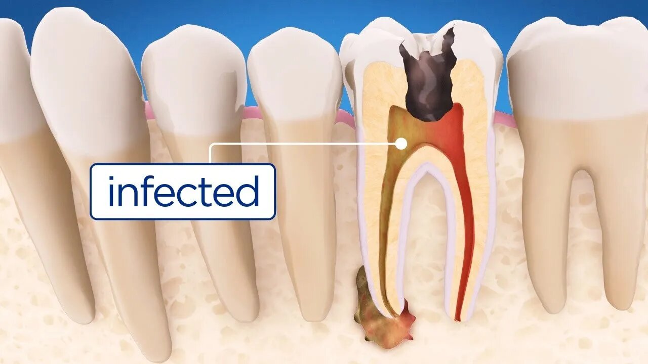 Steps for a Root Canal Procedure {by Dr. Domenico Ricucci}