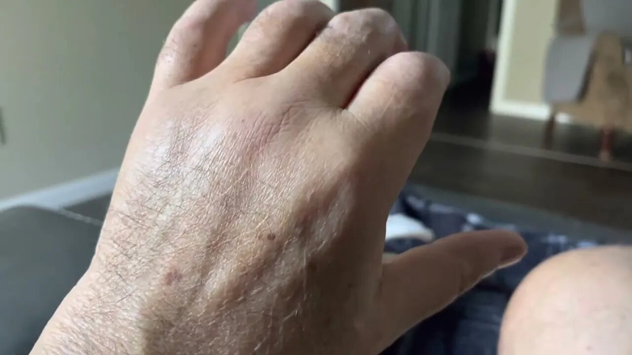 Psoriatic arthritis