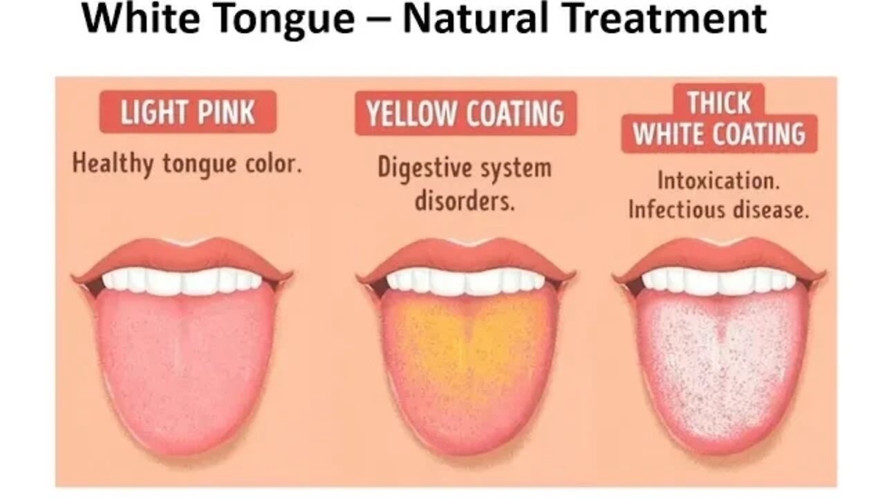 White Tongue - Natural Treatments & Causes