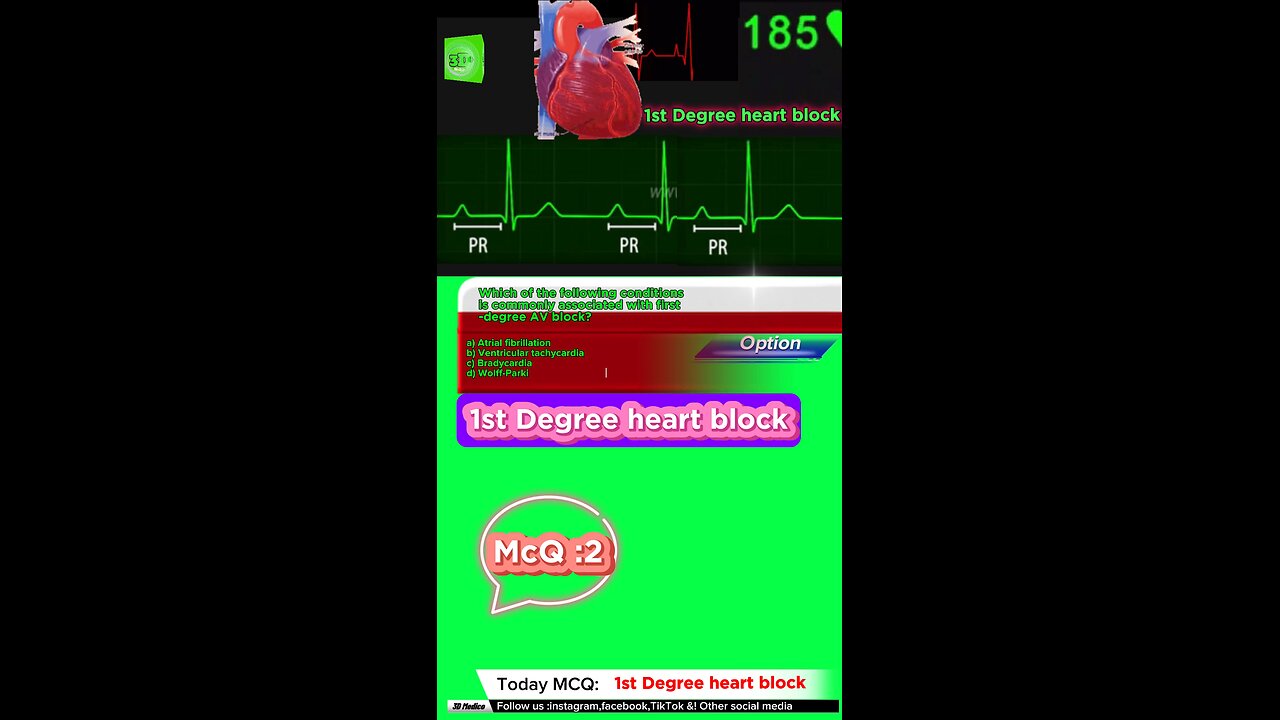 First degree heart blockages #firstdegreeavblock #arrthymias #CardiacArrhythmia #Cardiology