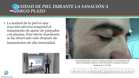 SANACION DE CORTO Y LARGO PLAZO ARETON