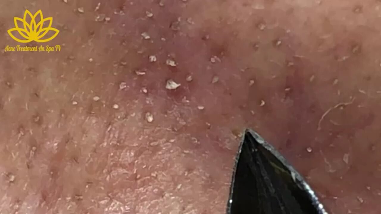 blackheads removal 4 OMG