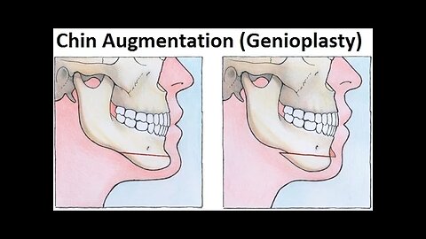 Treatment of Retruded Jaws/Mandible Using Genioplasty/Mentoplasty/Chin Augmentation by Dr Mike Mew