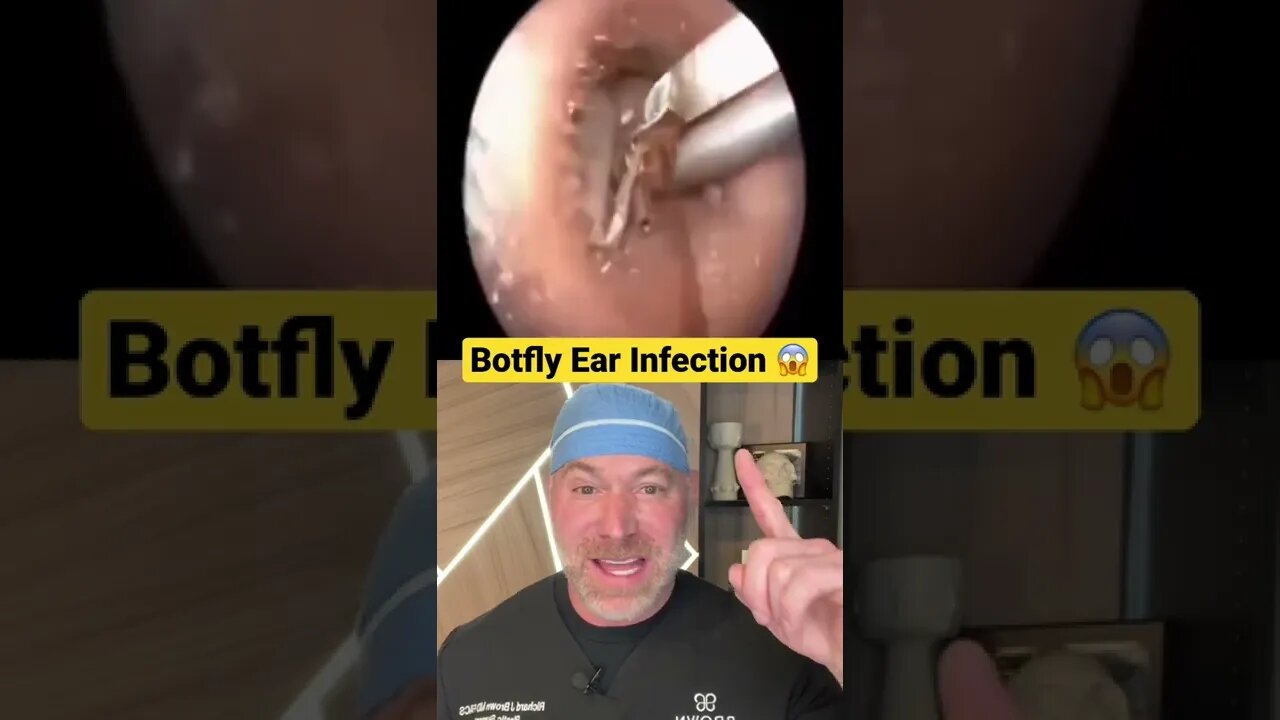 Botfly Ear Infection 😱 #shorts