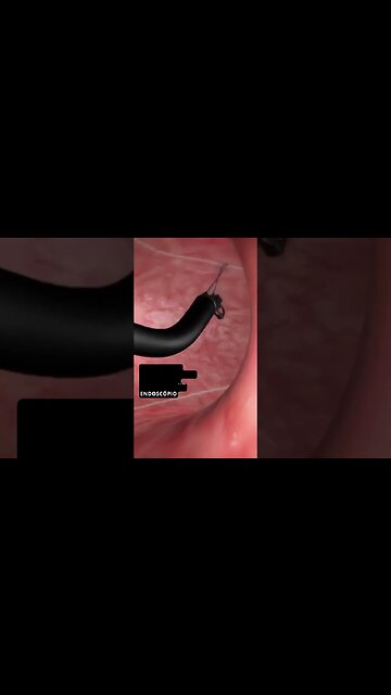 Como é Feita Gastroplastia endoscópica: Cada Vez Mais Usada #shorts #viral