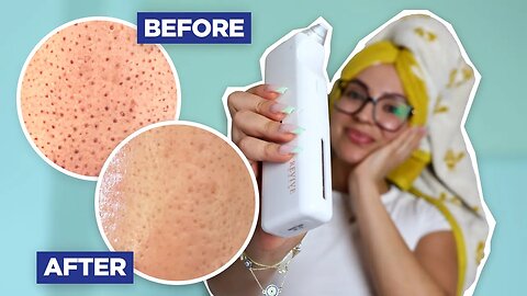How To Get Clear Skin (I Tried $250 Aqua HydraFacial at Home and This Is What Happened)
