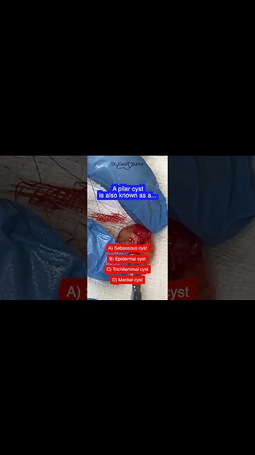 POP Quiz: Pilar Cysts