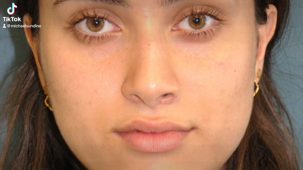 Preoperative and postoperative rhinoplasty 1