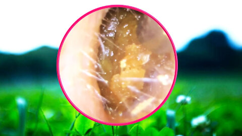 Ear Wax Removal With Clam Relaxing Music #18