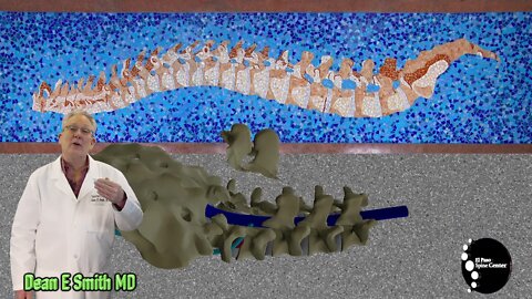 What Is a Lumbar Laminectomy?