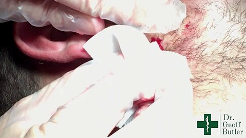 Drainage of an infected cyst of the face