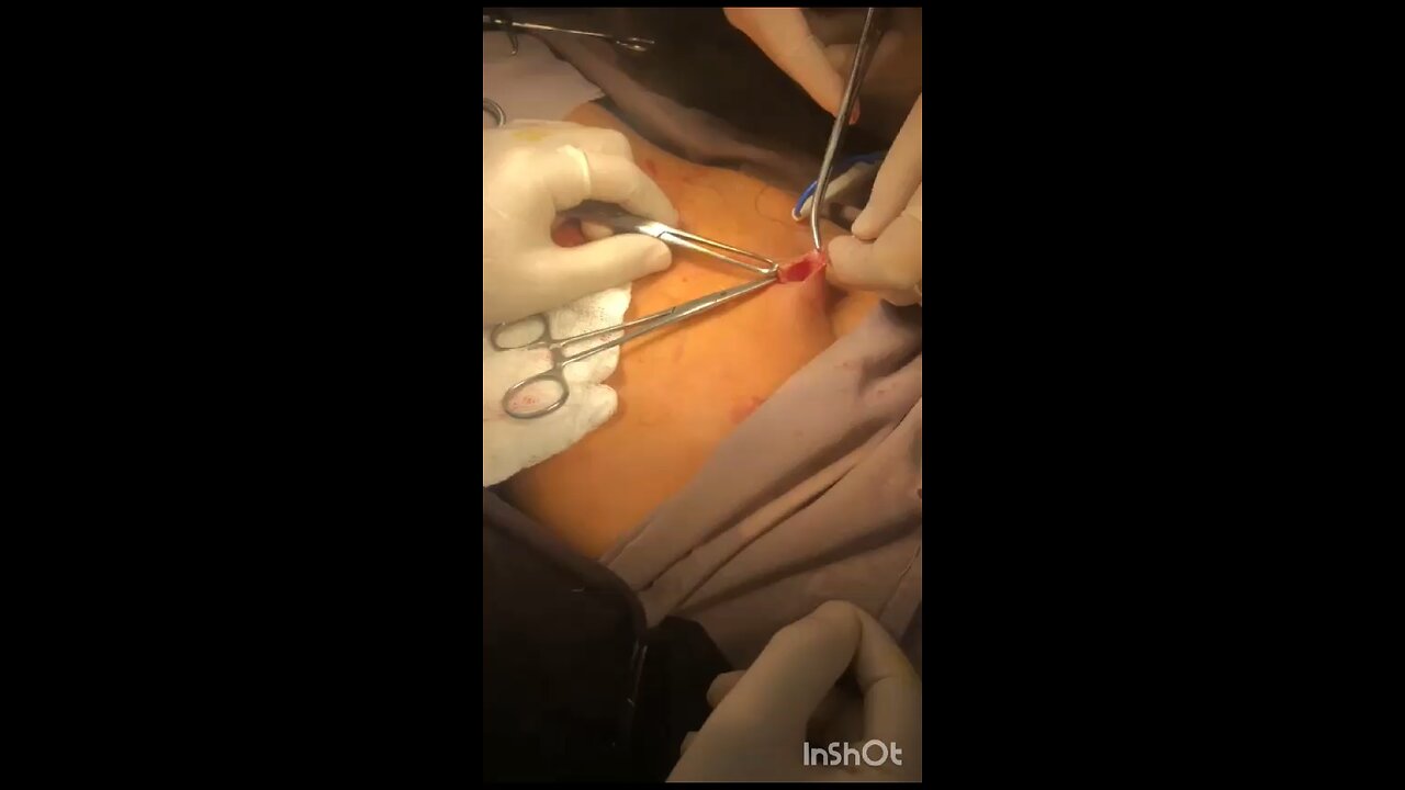 #MaleDSD#paedurology#case#B/L orchiodetomies#infertility
