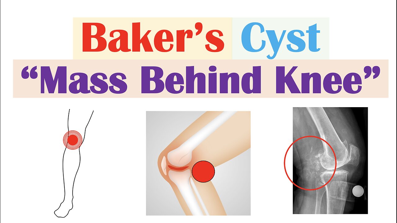 Baker Cyst (Popliteal Cyst) | Why They Occur, Symptoms, Diagnosis, Treatment