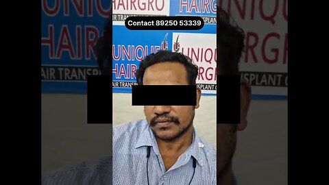 6 months hair transplant results | hair transplant in Chennai