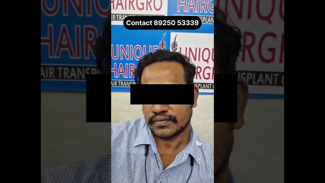 6 months hair transplant results | hair transplant in Chennai