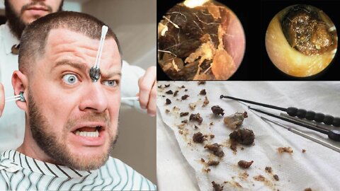 Ear wax removal | Satisfying video