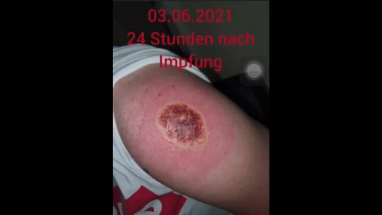 GRAPHIC!!! After jab...