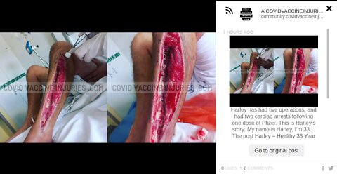 covid vaccine injuries