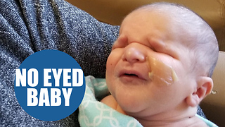 Parents shocked when told their new baby is born without eyes