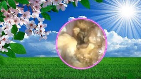 Cholesteatoma Earwax Removal #22