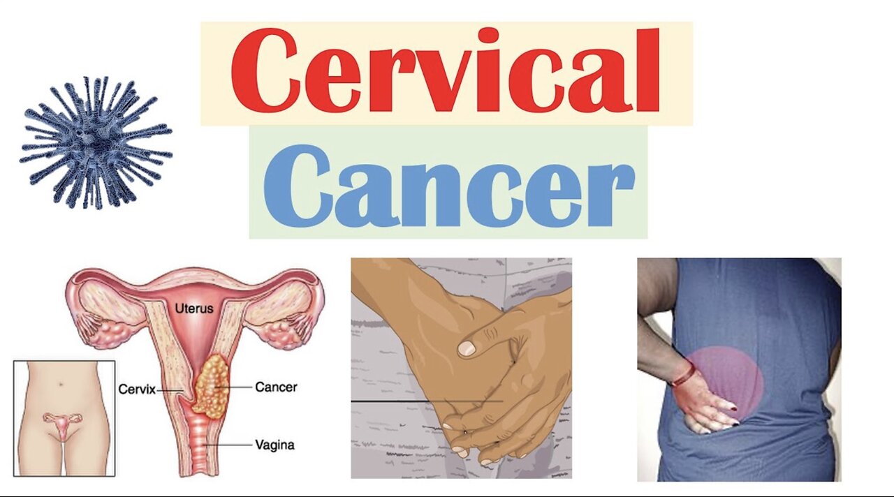 Cervical Cancer: Risk Factors, Pathophysiology, Symptoms, Staging, Diagnosis, Treatment & Prevention
