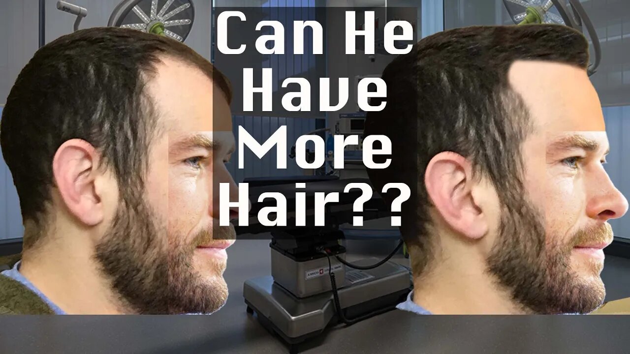 Hair Transplant Consultation #5 - Joe Tillman Reviews