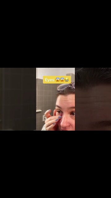 WTF ?!? Eyes pimple blackhead removal