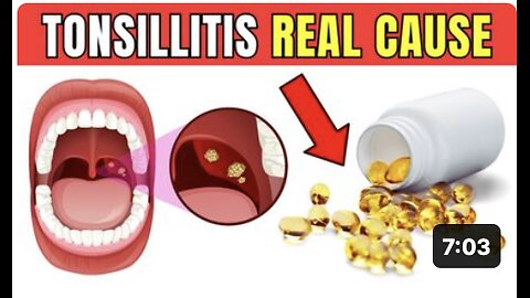 This is the REAL CAUSE of your recurring TONSILLITIS - it's not what you think!